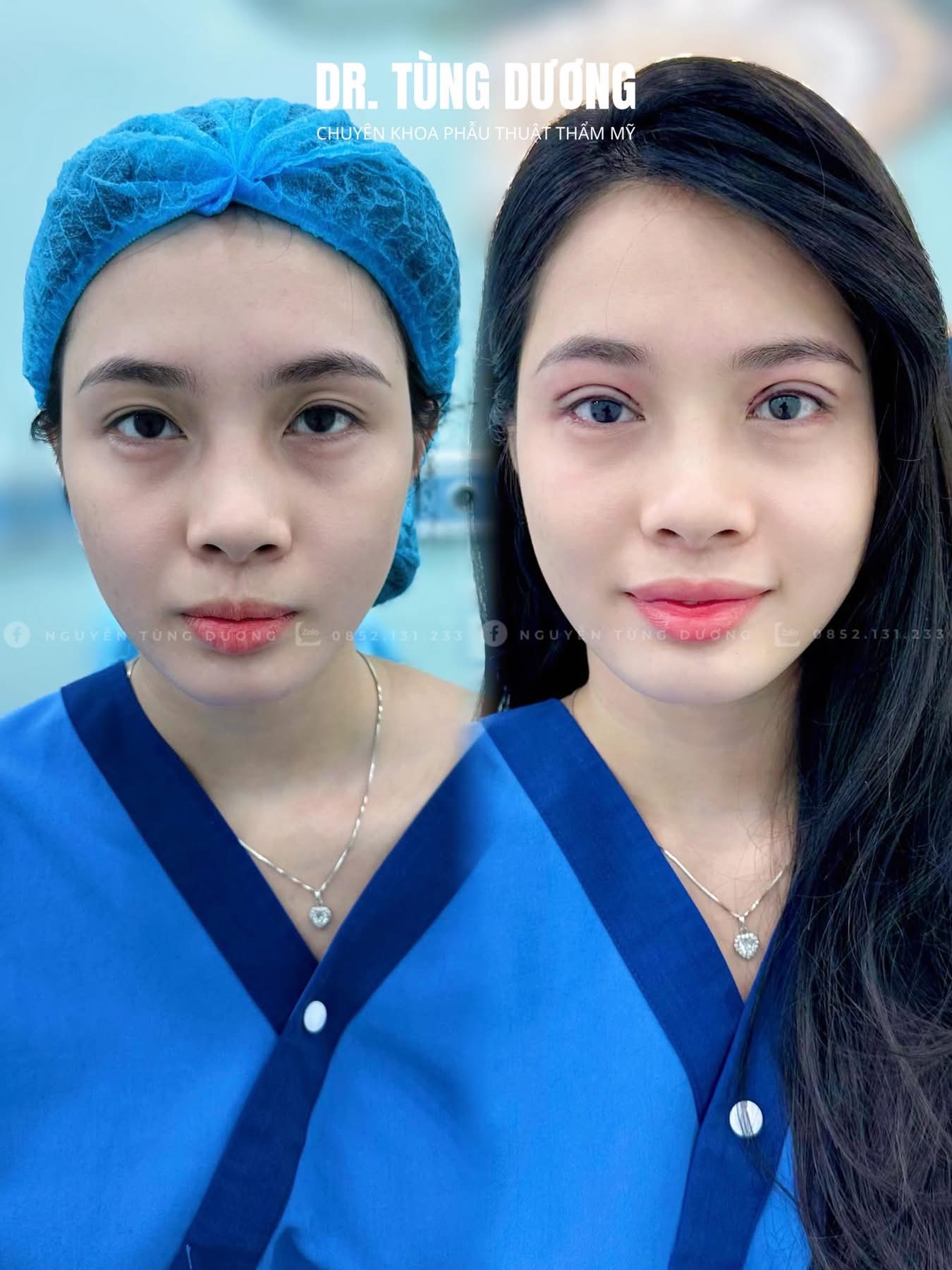 Tạo hình mí mắt Plasma