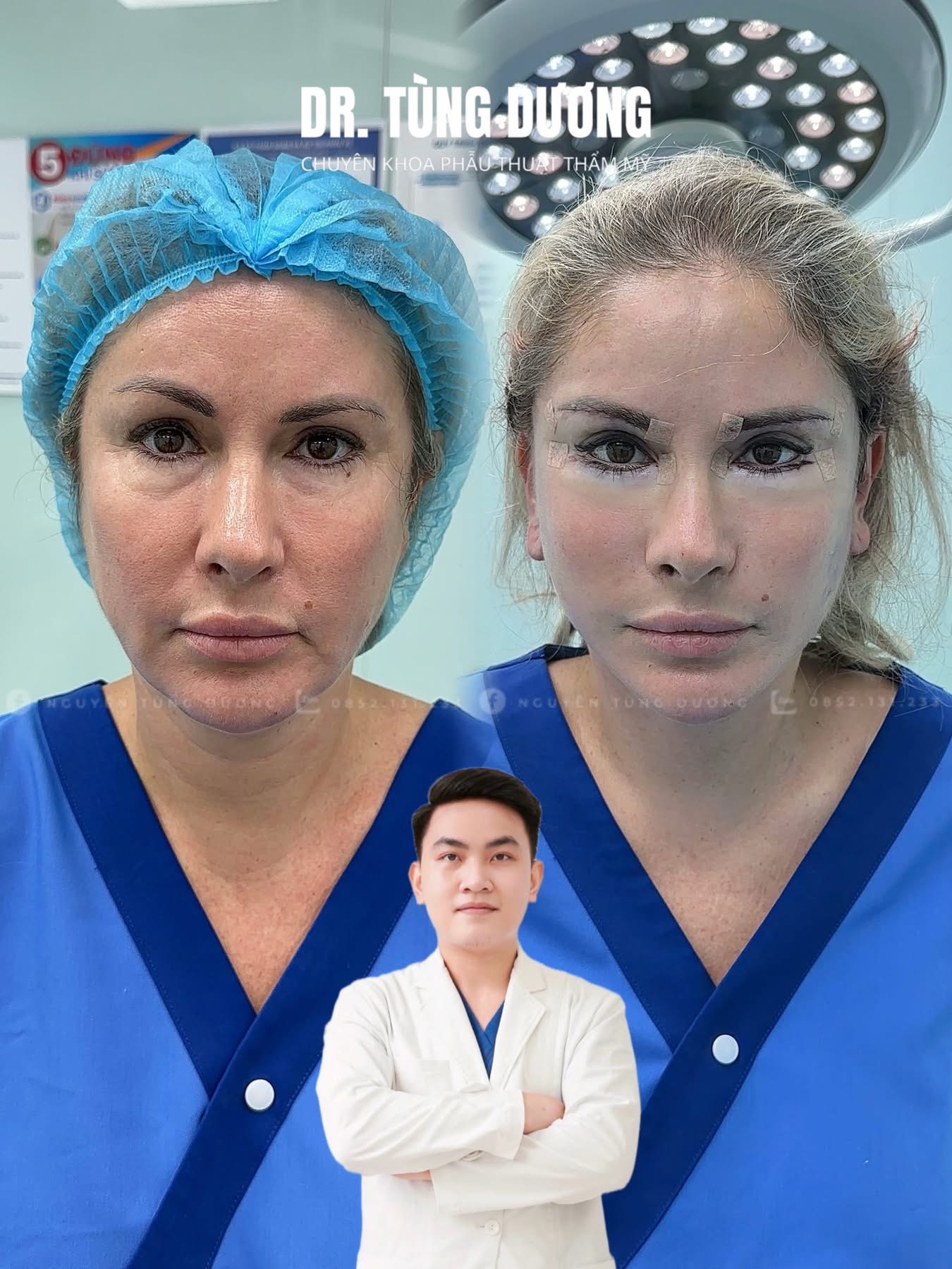 Căng da mặt Facelift
