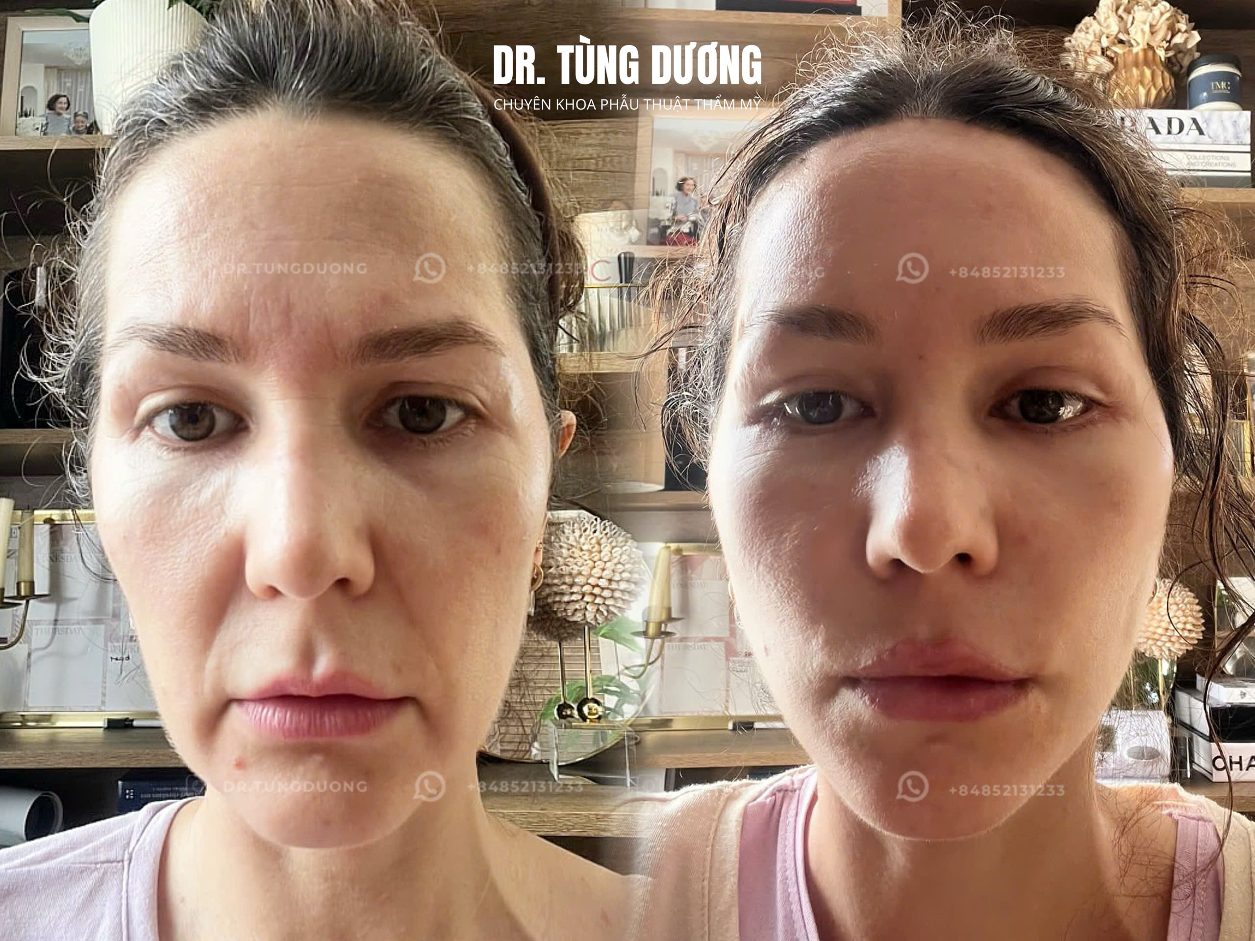 Phẫu thuật thực tế 4